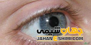 بیماری آب سیاه چیست؟ | دارو و درمان آب سیاه