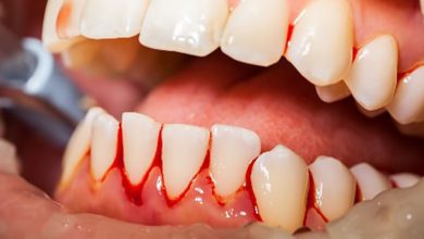 5 دلیل مهم خونریزی لثه چیست ؟ | دارو و درمان فوری خونریزی لثه