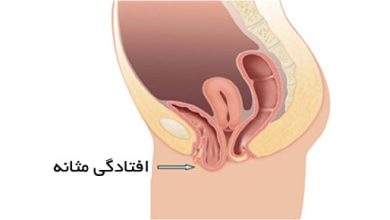 افتادگی مثانه در زنان چیست؟ | دارو و درمان افتادگی مثانه