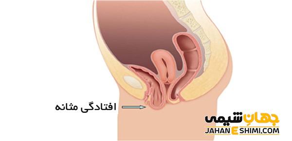 افتادگی مثانه در زنان چیست؟ | دارو و درمان افتادگی مثانه