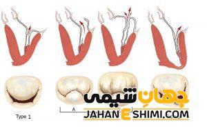 افتادگی دریچه قلب چیست؟ | دارو و درمان قطعی افتادگی دریچه قلب