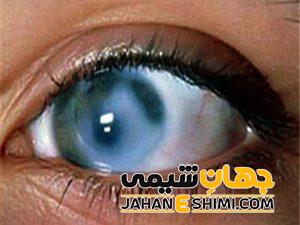 بیماری آب سیاه چیست؟ | دارو و درمان آب سیاه