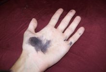 آیا لکه ‌های نیترات نقره روی پوست از بین می ‌رود؟