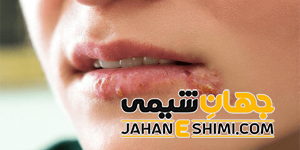 6 درمان سریع و خانگی تبخال | دارو و درمان فوری تبخال