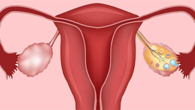 5 علت مهم تنبلی تخمدان چیست؟ | دارو و درمان فوری تنبلی تخمدان