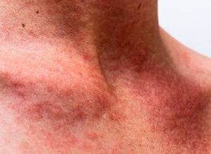 دارو و درمان فوری و خانگی عرق سوز شدن | علت عرق سوز شدن چیست