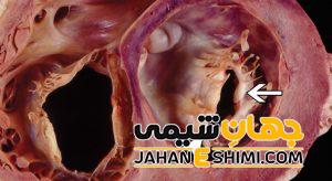 افتادگی دریچه قلب چیست؟ | دارو و درمان قطعی افتادگی دریچه قلب