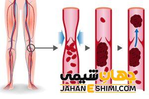 5 دلیل ایجاد لخته خون در بدن | آیا لخته خون خطرناک است؟
