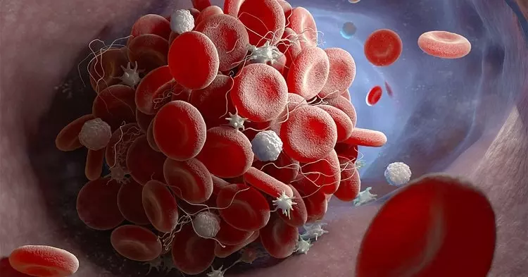 5 دلیل ایجاد لخته خون در بدن | آیا لخته خون خطرناک است؟