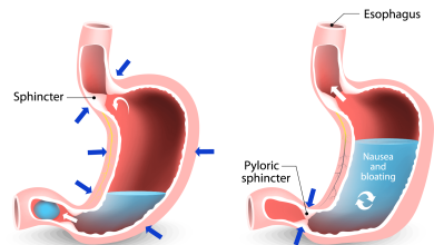 معجزه درمان بیماری فلج معده در طب سنتی علت و داروی فلج معده
