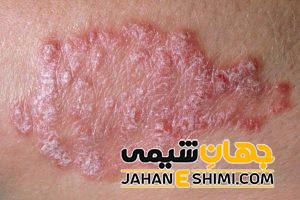 بیماری لوپوس چیست؟ | دارو و درمان لوپوس چیست؟