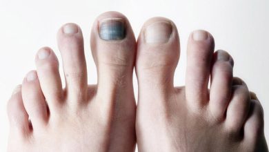 5 دلیل بروز سیاه شدن ناخن پا | دارو و درمان سیاه شدن ناخن پا