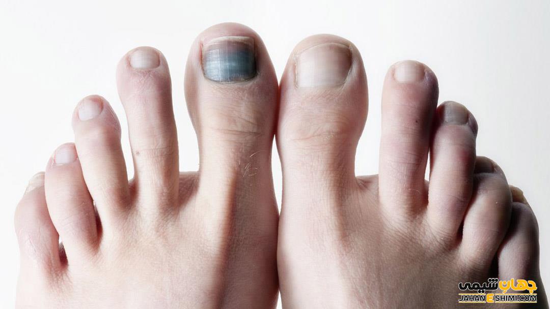 5 دلیل بروز سیاه شدن ناخن پا | دارو و درمان سیاه شدن ناخن پا