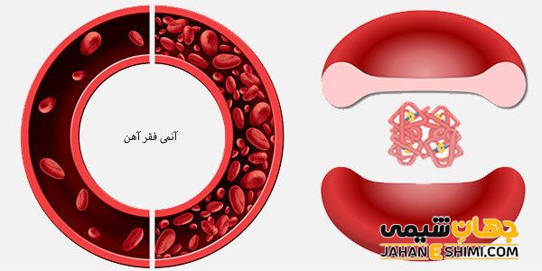 فقر آهن و کم خونی چه ارتباطی دارند؟ | راه های درمان فقر آهن و کم خونی
