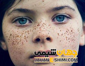 5 دلیل بروز کک و مک در صورت | دارو و درمان کک و مک