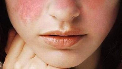 بیماری لوپوس چیست؟ | دارو و درمان لوپوس چیست؟