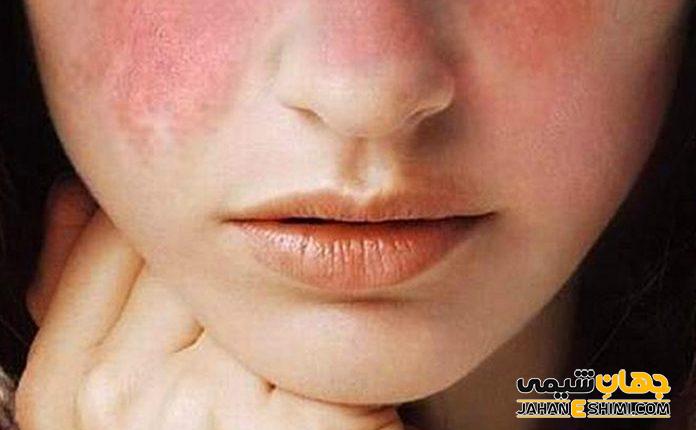 بیماری لوپوس چیست؟ | دارو و درمان لوپوس چیست؟