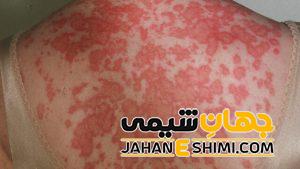 بیماری لوپوس چیست؟ | دارو و درمان لوپوس چیست؟
