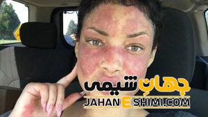 بیماری لوپوس چیست؟ | دارو و درمان لوپوس چیست؟