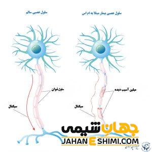 بیماری ام اس چیست؟ | دارو و درمان بیماری ام اس
