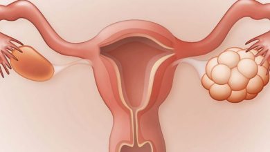 5 دلیل نارسایی تخمدان چیست؟ | دارو و درمان نارسایی تخمدان
