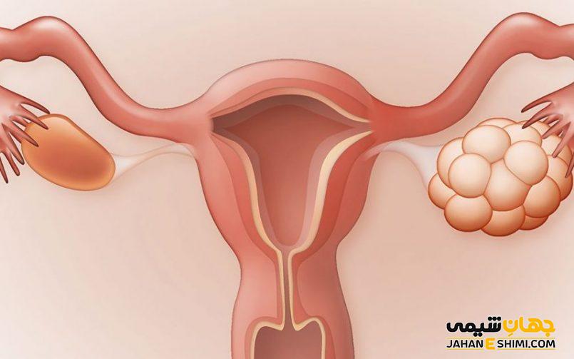 5 دلیل نارسایی تخمدان چیست؟ | دارو و درمان نارسایی تخمدان