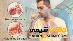 3 دلیل ابتلا به سینه پهلو | دارو و درمان سینه پهلو