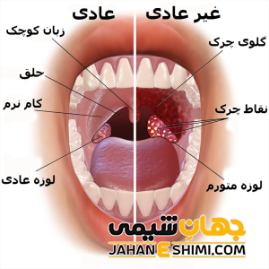 5 دلیل بروز التهاب لوزه و راه درمان آن | دارو و درمان التهاب لوزه