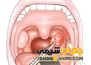5 دلیل بروز التهاب لوزه و راه درمان آن | دارو و درمان التهاب لوزه