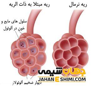 3 دلیل ابتلا به سینه پهلو | دارو و درمان سینه پهلو