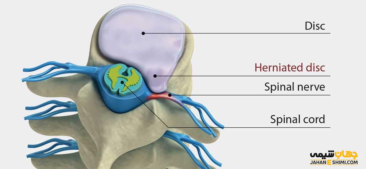 دیسک بین مهره ای چیست