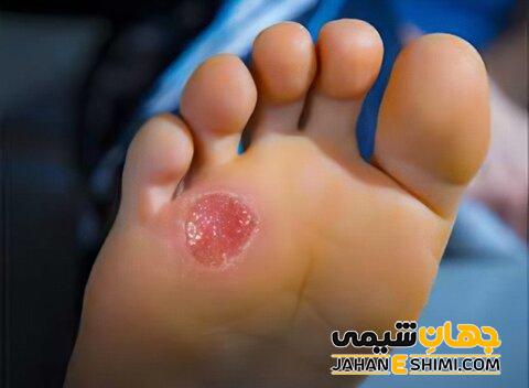 درمان قطعی زخم دیابتی چیست؟ | دلیل ایجاد زخم دیابتی