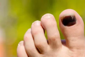 5 دلیل بروز سیاه شدن ناخن پا | دارو و درمان سیاه شدن ناخن پا