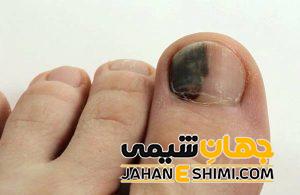 5 دلیل بروز سیاه شدن ناخن پا | دارو و درمان سیاه شدن ناخن پا