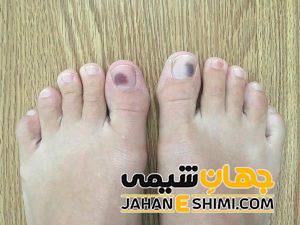 5 دلیل بروز سیاه شدن ناخن پا | دارو و درمان سیاه شدن ناخن پا