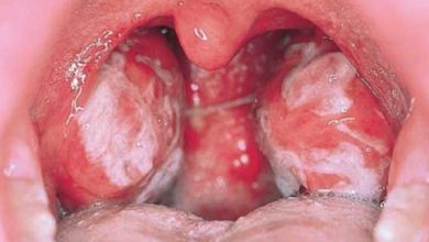 5 دلیل بروز التهاب لوزه و راه درمان آن | دارو و درمان التهاب لوزه