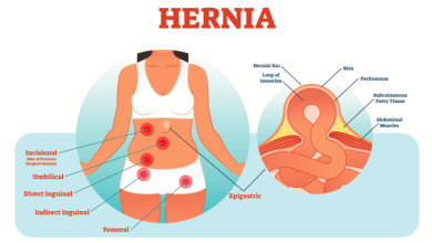 علت ایجاد فتق چیست / راههای پیشگیری و درمان های خانگی فتق