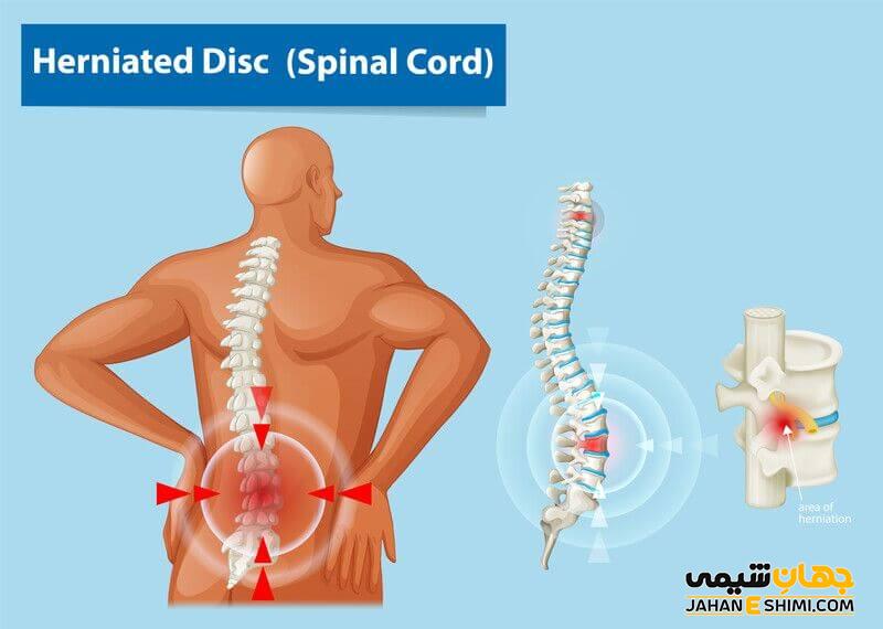 عمل فتق دیسک بین مهره ای