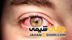 8 علامت خستگی چشم چیست ؟ | درمان فوری و خانگی خستگی چشم