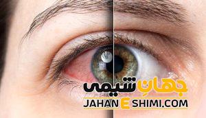 8 علامت خستگی چشم چیست ؟ | درمان فوری و خانگی خستگی چشم