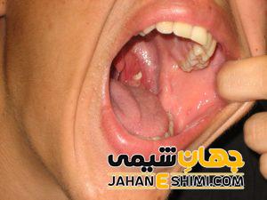 5 دلیل بروز التهاب لوزه و راه درمان آن | دارو و درمان التهاب لوزه