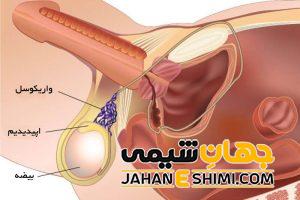 واریکوسل چیست؟ | دارو و درمان واریکوسل