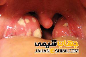5 دلیل بروز التهاب لوزه و راه درمان آن | دارو و درمان التهاب لوزه