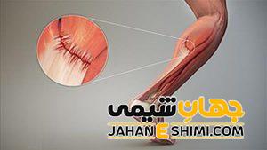 5 درمان فوری و شگفت انگیز برای کشیدگی عضلات