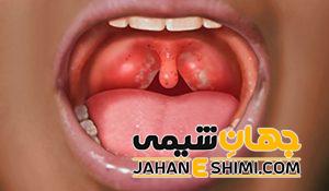 10 دلیل بروز گلودرد چیست؟ | دارو و درمان فوری و خانگی گلودرد
