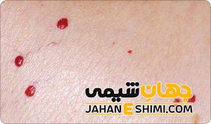 خال‌ های قرمز، سیاه و سبز روی بدن نشانه چیست؟ | جهان شیمی فیزیک