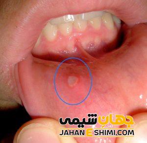 تبخال داخل دهان چگونه ایجاد می شود؟ | دارو و درمان تبخال داخل دهان
