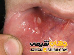 تبخال داخل دهان چگونه ایجاد می شود؟ | دارو و درمان تبخال داخل دهان