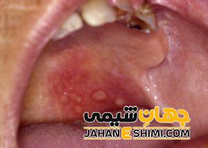 تبخال داخل دهان چگونه ایجاد می شود؟ | دارو و درمان تبخال داخل دهان