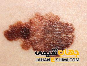 خال های قرمز، سیاه و سبز روی بدن نشانه چیست؟